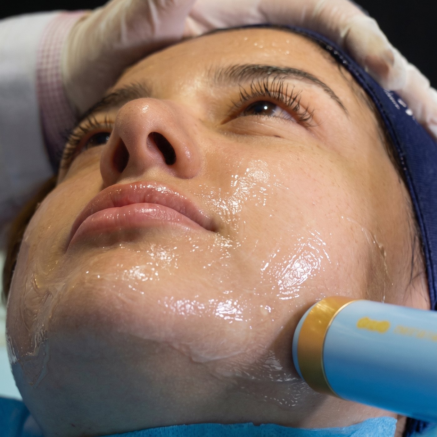 Tratamiento facial sin inyectables